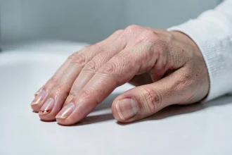 Gros plan sur un ongle de doigt présentant les premiers signes d'infiltration avec rougeur et gonflement autour de la cuticule